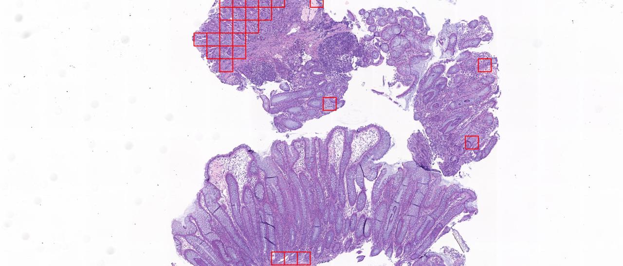 Imagen H&E de una biopsia de colon con las regiones afectadas por carcinoma identificadas en rojo